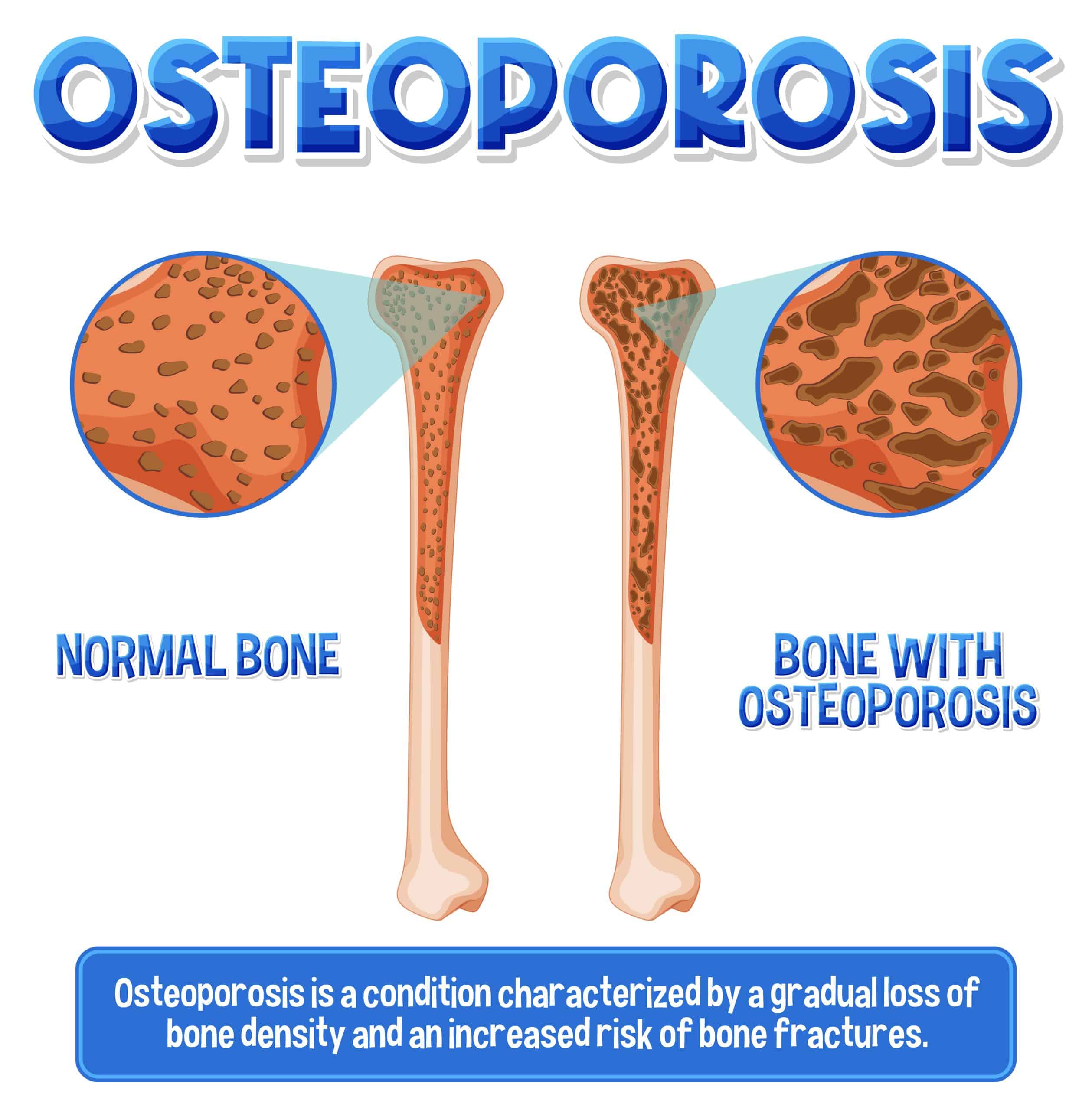 La Osteoporosis y la importancia del cuidado óseo