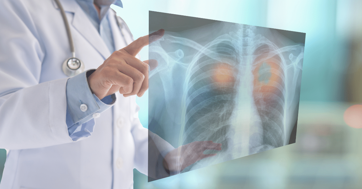 Cáncer de Pulmón
