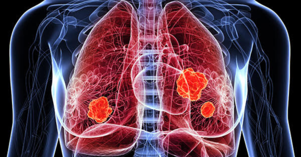 Cáncer de Pulmón