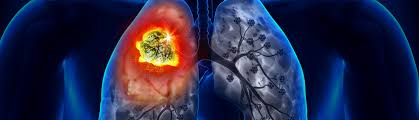 Cáncer de Pulmón
