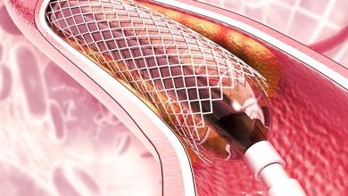 Angioplastia