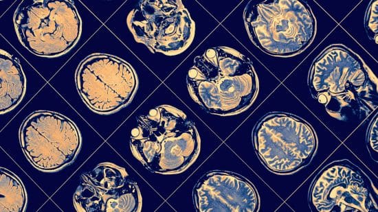 cerebrovascular