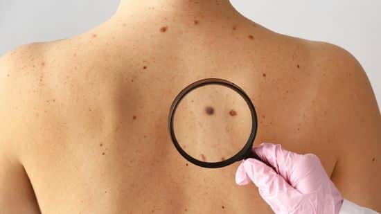 cáncer